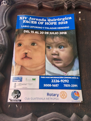 The Faces of Hope Program.  There is an unusually high rate of cleft lip and cleft palate in Guatemala.  Doctors donate their time to perform corrective surgeries.  Support from local teams incudes Companeros Cirugia, local patrons and Rotary Clubs.  Families travel 10+ hours by bus and on foot from rural Guatemala.